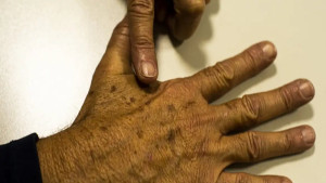 Mutirão de prevenção ao câncer de pele acontece em sete municípios baianos neste sábado